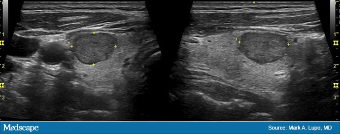 assessing-thyroid-nodules-a-clinician-s-guide