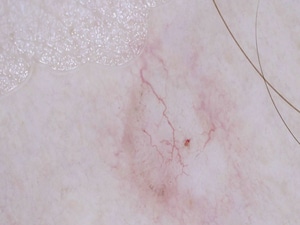 Expert Offers Tips for Sorting Out Pink Lesions on Dermoscopy