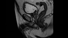 tumor bladder urine