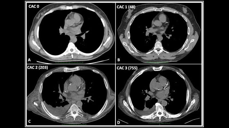 Coronary Calcium Bests Polygenic Risk Score to Predict CHD