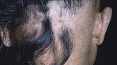 Hair Disorders: Finding the Root of the Problem