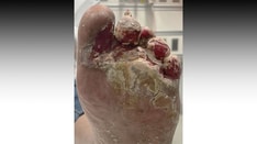 Worsening Foot Wound in a 50-Year-Old Marathon Runner