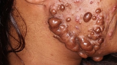 Identifying Lesions on Skin of Color