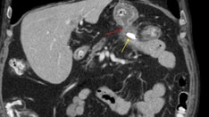 Chronic Abdominal Pain After Colonoscopy