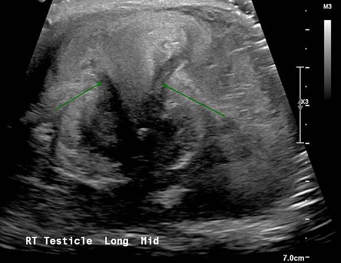 Acute Unilateral Testicular Pain in a 66-Year-Old Patient - Page 3