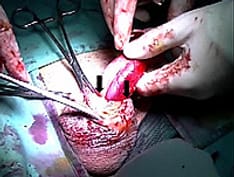 An Unusual Delayed Complication of Paraffin Self-injection for Penile Girth Augmentation