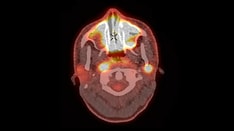 MSK Pediatrics e-Tumor Boards: Case 2: Multisystem Rosai-Dorfman Disease