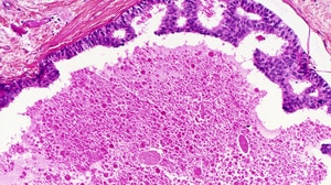 Metastatic Breast Cancer