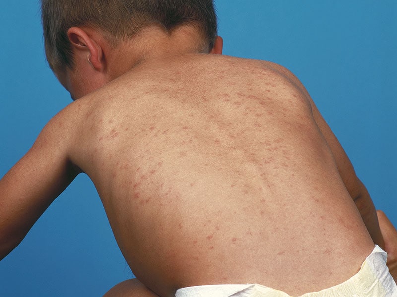 Special Report: Measles 2014