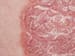 Biologics Maintain Benefits Long-term in Plaque Psoriasis