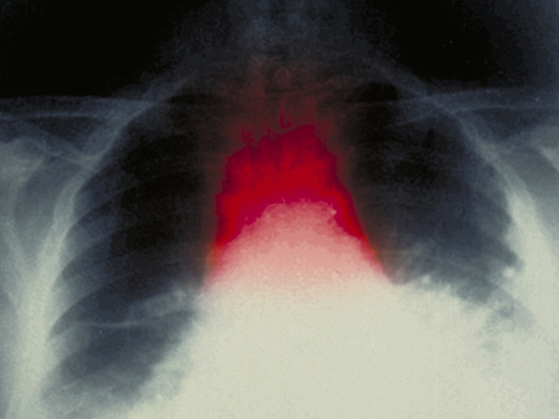 Anthim Anthrax Antitoxin Obiltoxaximab Dosing Indications   Ps 160324 Anthrax Inhalation Xray 800x600 