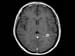 Change to MRI Criteria Would Diagnose MS Earlier