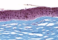 Corneal Crosslinking: A Look at Data That Convinced the FDA