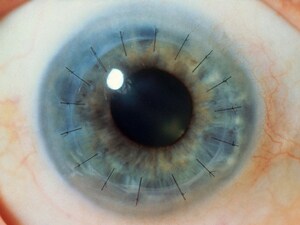 American Glaucoma Society Ags 2017 Annual Meeting