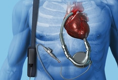 Pediatric Ventricular Assist Devices