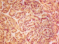 Which Patients Will Progress To Kidney Failure After Surgery