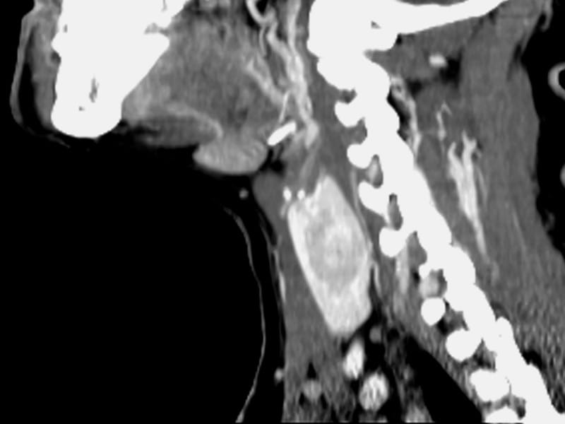 For Five Cancers, Screening Skews Risk Factors