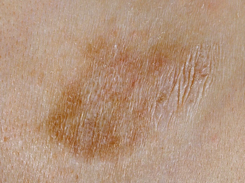 Stem Cell Transplant Improves Severe Scleroderma Survival