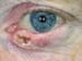 Steady Increase in Eyelid Cancer Found in England