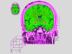 Parkinsonism: Not Just a Motor Problem