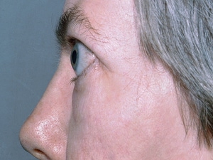 IGF1-Targeting Teprotumumab Tackles Thyroid Eye Disease