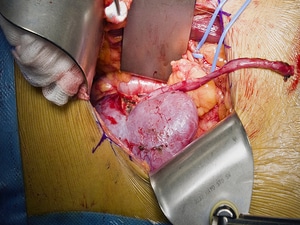 Prioritizing Transplants When Other Surgeries Are on Hold