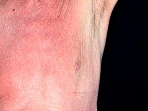 Ixazomib Shows Promise As Option For Chronic Gvhd