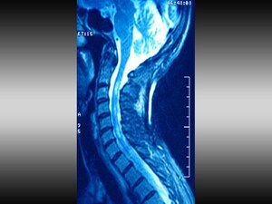 Spinal Cord Atrophy Greater in Secondary Progressive MS