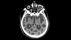 Fast Five Quiz: Do You Know the Risk Factors, Symptoms, and Potential Treatments for Alzheimer's Disease?