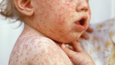 Measles Concerns Over Missed Vaccinations