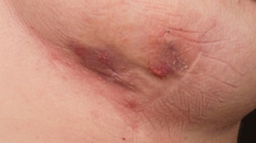 Fast Five Quiz: Hidradenitis Suppurativa Management