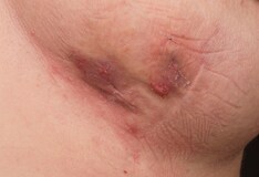 Painful Inflamed Skin Helped With Stronger Drug Dosing