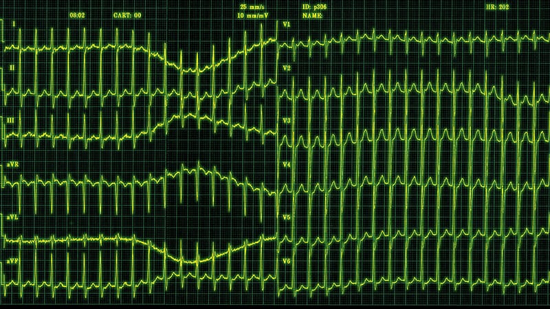 New ESC Guideline on SVT Management: Catheter Ablation Key