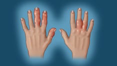 Fast Five Quiz: Psoriatic Arthritis Presentation and Diagnosis