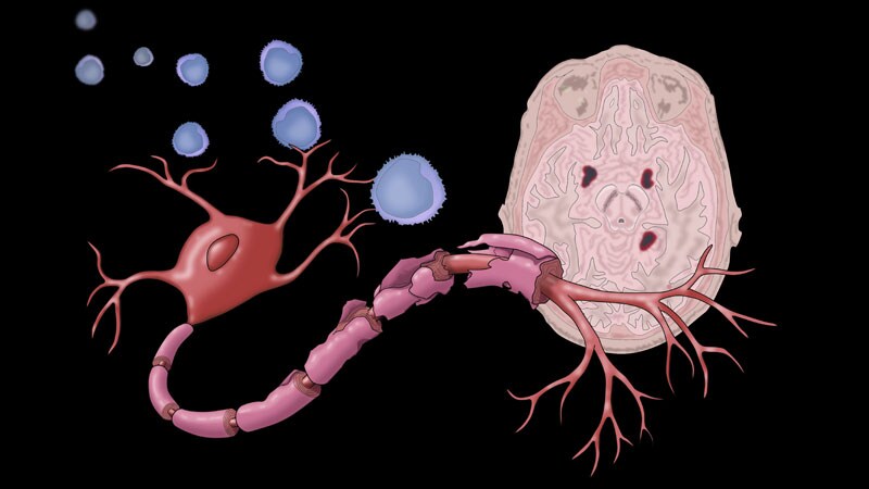 Etanercept Injection Site Reaction