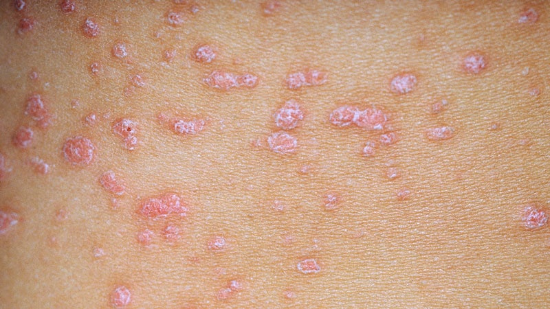 Psoriasis