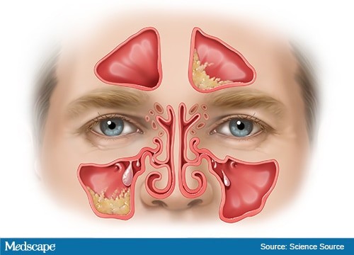 infected nasal polyp