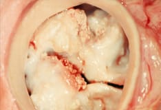Mitral Stenosis Differential Diagnoses