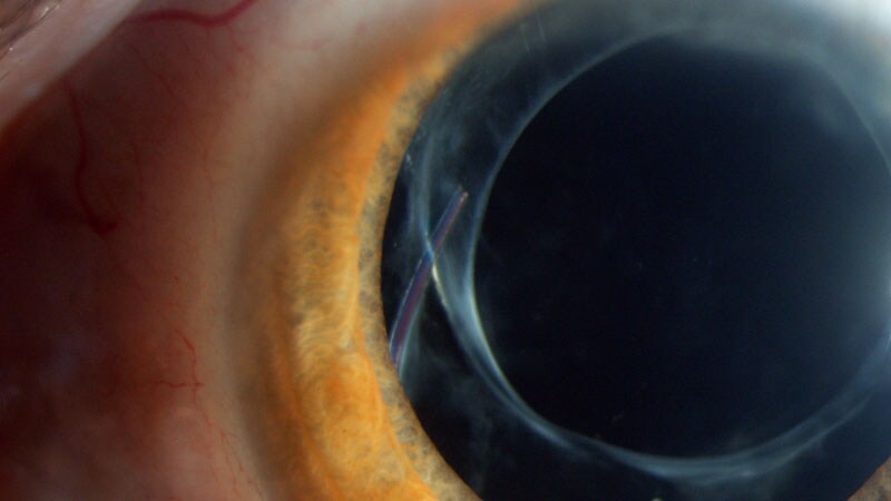 Phacoemulsification With Intraocular Lens (IOL) Implantation Medication ...