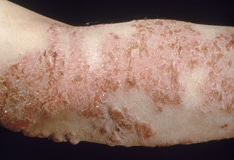 Eczema Herpeticum A Dermatologic Emergency