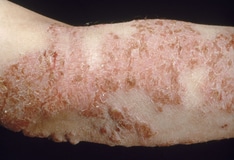 Eczema Herpeticum A Dermatologic Emergency Eczema Herpeticum A Dermatologic Emergency