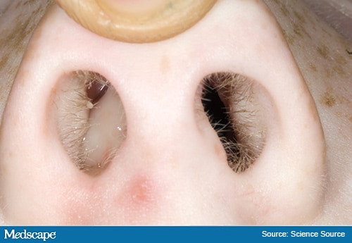 Fast Five Quiz: Pediatric Nasal Polyps - Page 2