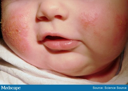 Fast Five Quiz: Pediatric Atopic Dermatitis - Page 2