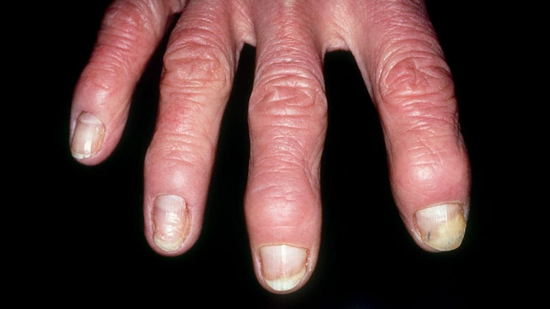 Psoriatic Arthritis - Medscape