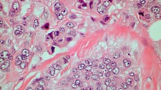 Fast Five Quiz: Breast Cancer Presentation and Diagnosis