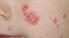 plaque psoriasis medscape