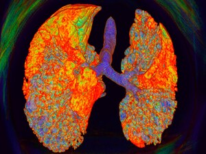 Fibrosis Progression Flies Below the Radar in Subclinical ILD