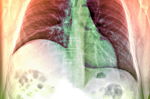 Fast Five Quiz: Alpha-1 Antitrypsin Deficiency Presentation - Page 5