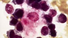 Fast Five Quiz: Advanced and Metastatic Breast Cancer Practice Essentials