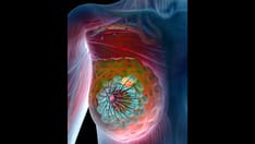 Fast Five Quiz: HER2-positive Metastatic Breast Cancer Management